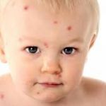 Как лечить аллергию у детей