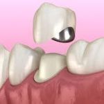 Металлокерамика зубов